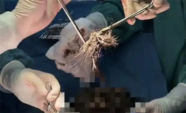 15岁少女啃发成瘾，胃中惊现4斤发石！