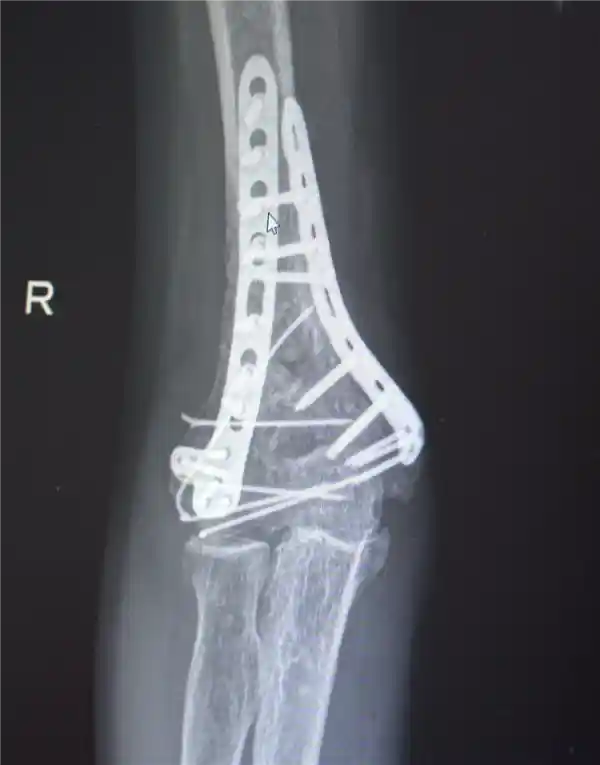 男子高空坠落碎骨30多块 医生拼图手术奇迹救回