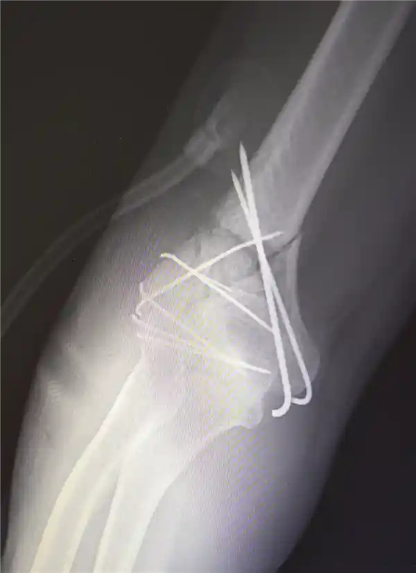 男子高空坠落碎骨30多块 医生拼图手术奇迹救回