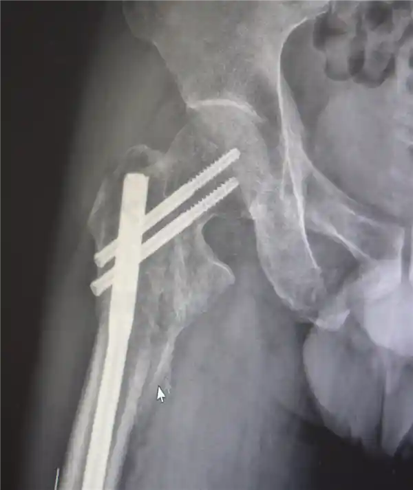 男子高空坠落碎骨30多块 医生拼图手术奇迹救回