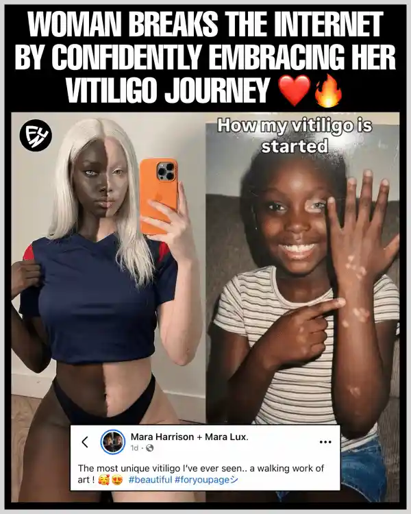 白袍女孩引爆网络：白癜风肌肤竟成另类美学新宠